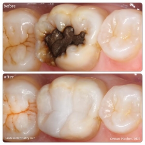 Amalgam filling replaced with white tooth-colored composite by Dr. Mechev, La Mesa Dental Center