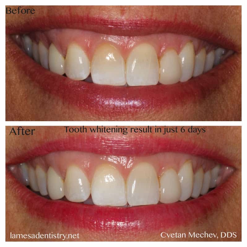 teeth whitening