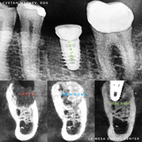 Bone grafting procedure for dental implants, La Mesa Dental Center