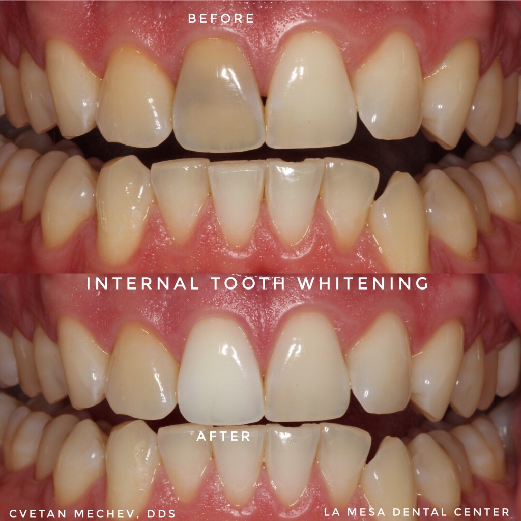 Internal teeth whitening San Diego patient result by Dr. Mechev, La Mesa Dental Center