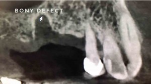 Dental bone defect and ridge augmentation by Dr. Cvetan Mechev, La Mesa Dental Center