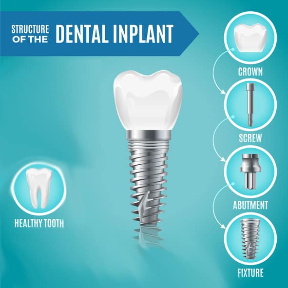 Single tooth dental implant structure diagram — Dr. Cvetan Mechev, La Mesa Dental Center