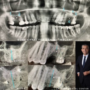 Dental implants La Mesa Dental Center result by Dr. Cvetan Mechev