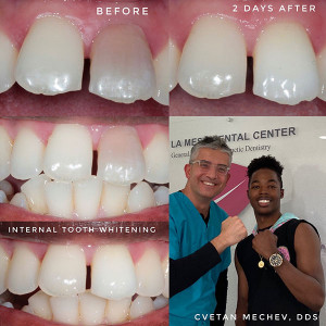 Internal teeth whitening before and after by Dr. Mechev, La Mesa Dental Center