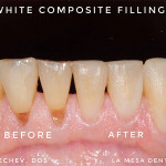 Composite filling treatment of teeth erosion by Dr. Mechev, La Mesa Dental Center