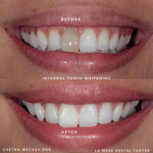 Internal tooth whitening before and after by Dr. Mechev, La Mesa Dental Center