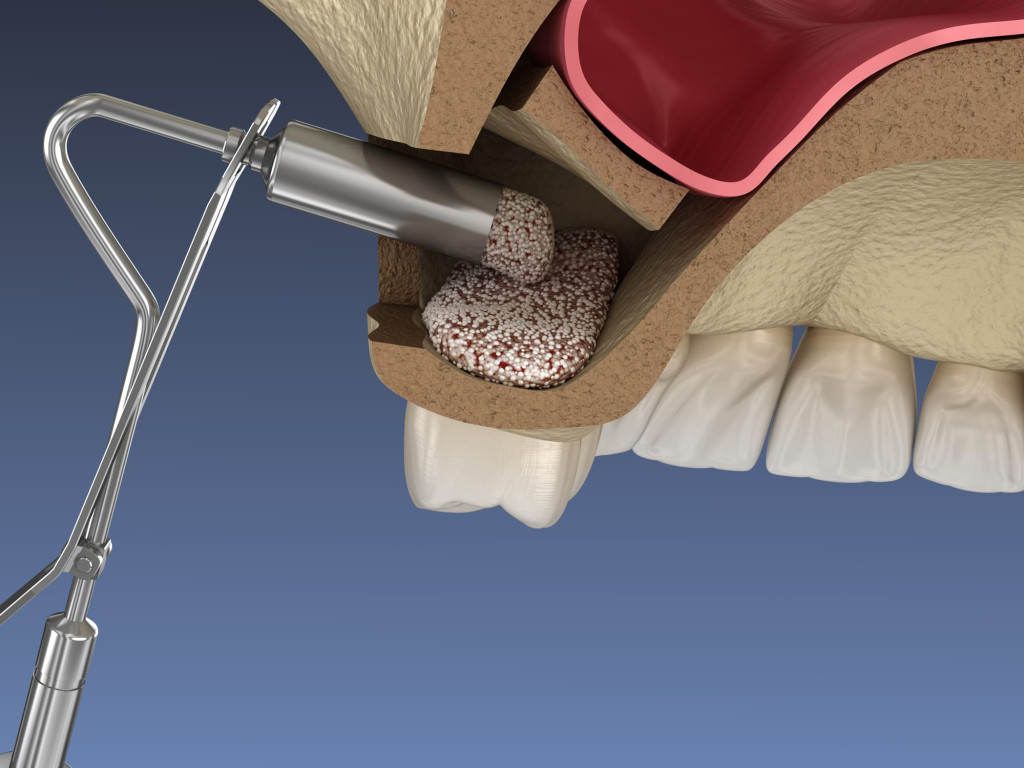 3D illustration of sinus lift bone grafting in the upper jaw at La Mesa Dental Center