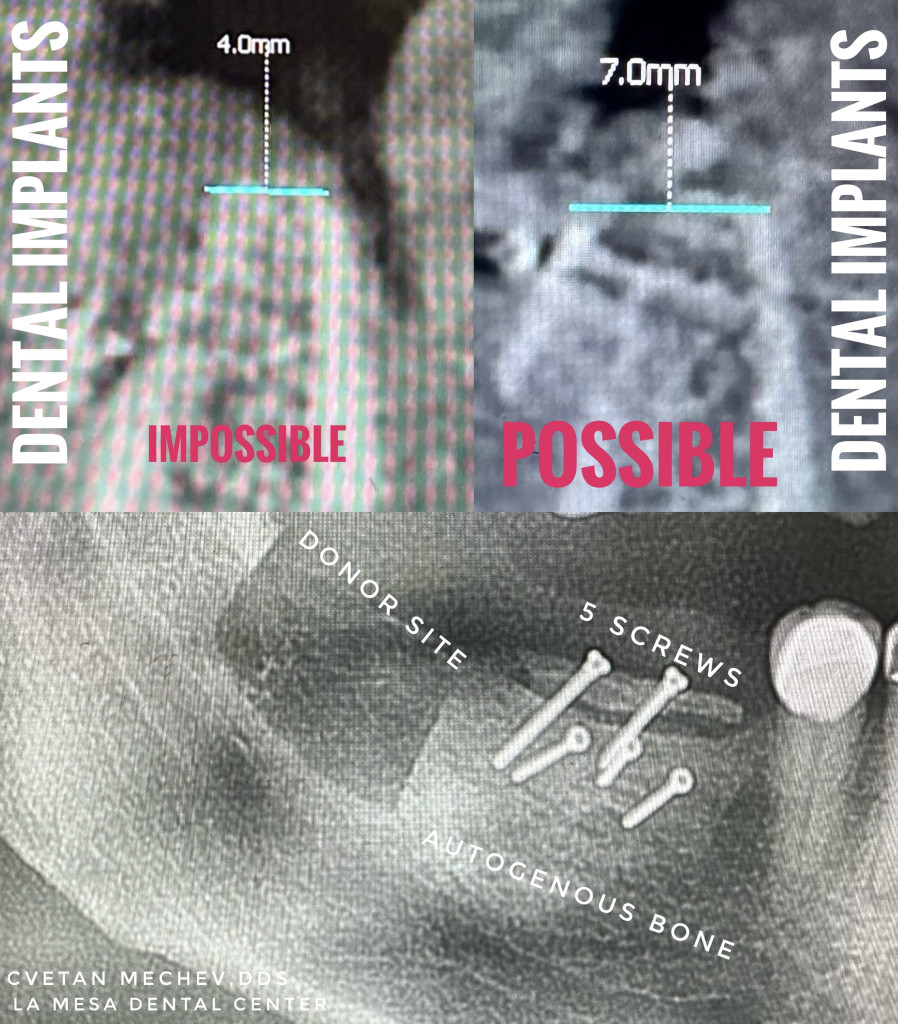 Before and after CBCT images of horizontal bone ridge augmentation by Dr. Cvetan Mechev at La Mesa Dental Center