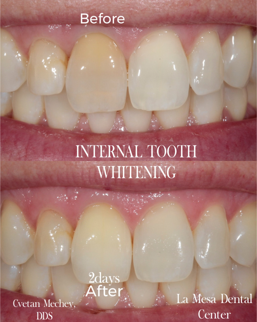 Internal teeth whitening before and after 2025 by Dr. Mechev, La Mesa Dental Center