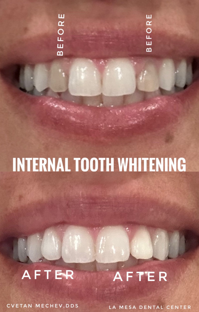 Dead tooth whitening before and after by Dr. Mechev, La Mesa Dental Center