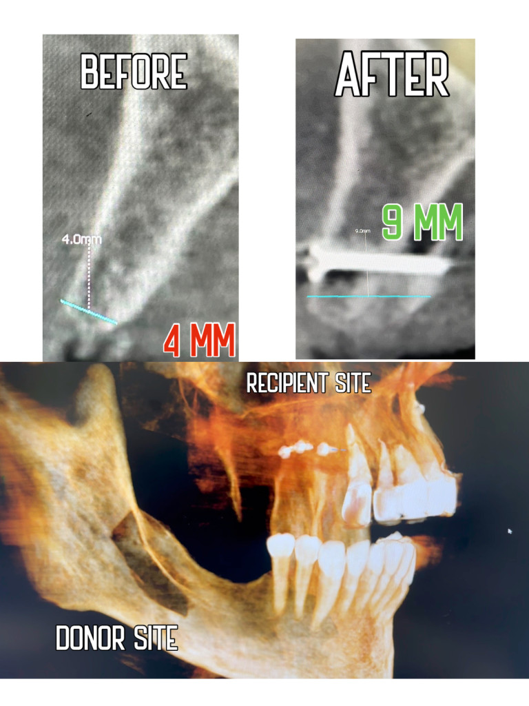 CBCT before and after horizontal bone ridge augmentation, Dr. Cvetan Mechev, La Mesa Dental Center