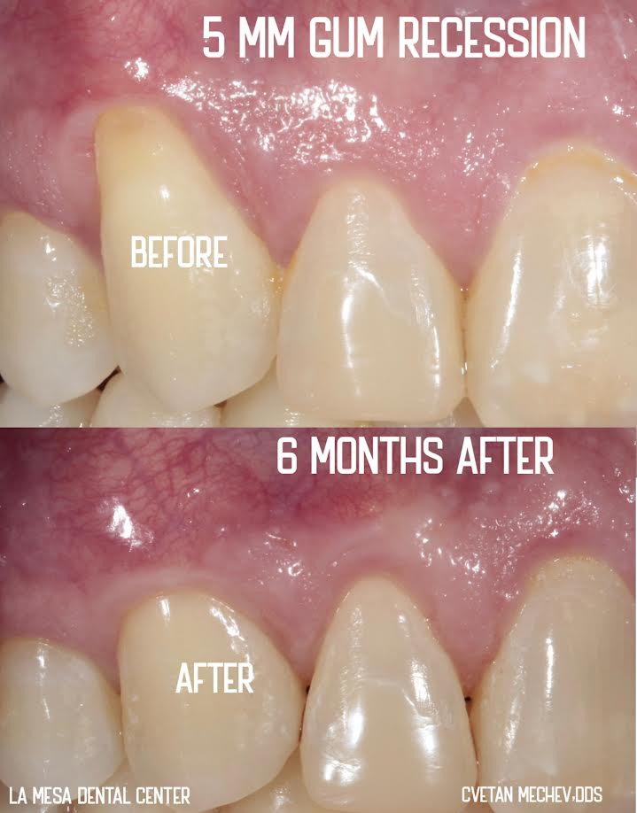 San Diego dentist Dr. Cvetan Mechev treating 5 mm gum recession using minimally invasive Alloderm gum graft at La Mesa Dental Center.