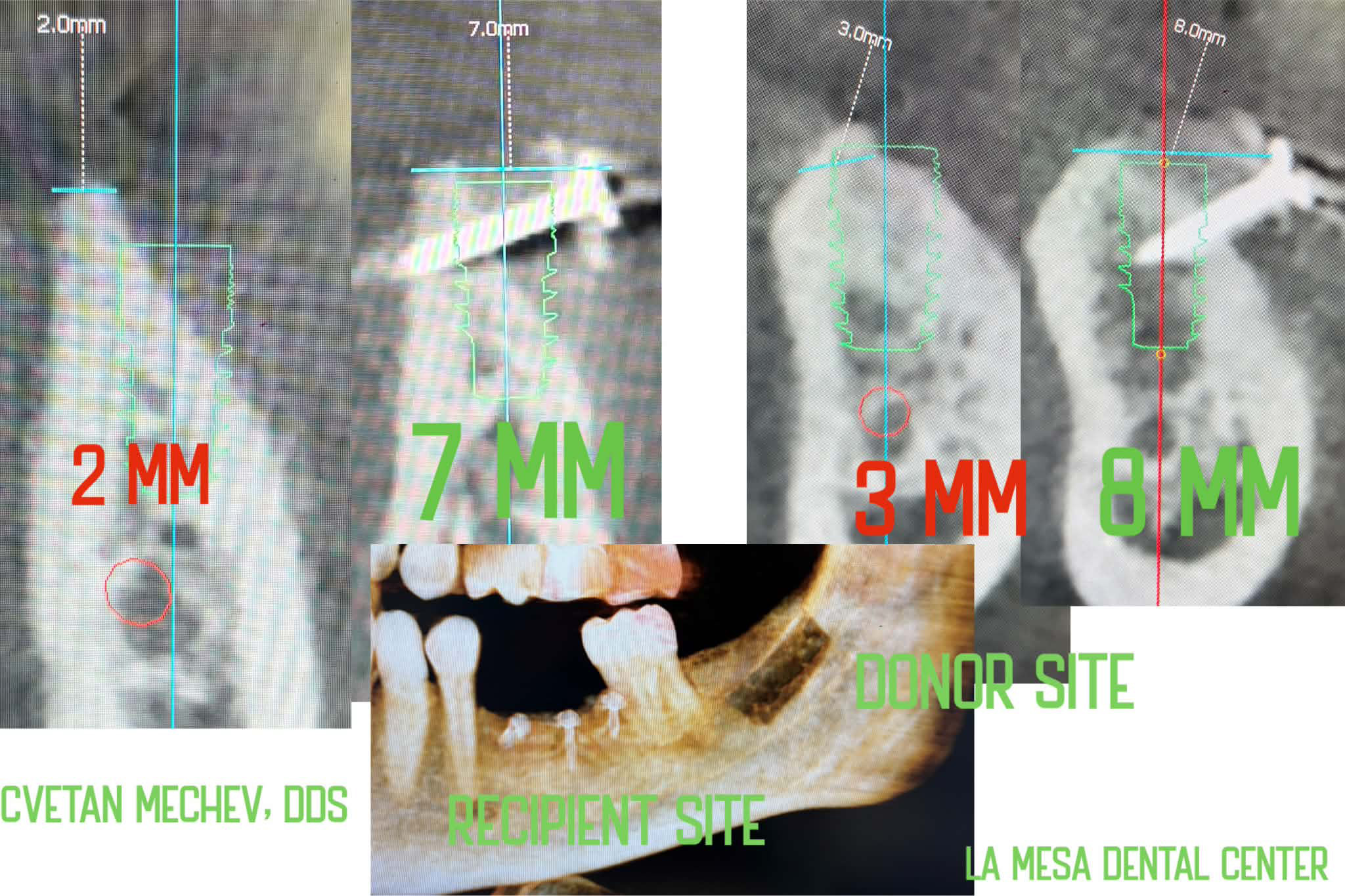 CBCT scan showing 2mm to 8mm horizontal bone augmentation — Dr. Cvetan Mechev, La Mesa Dental Center