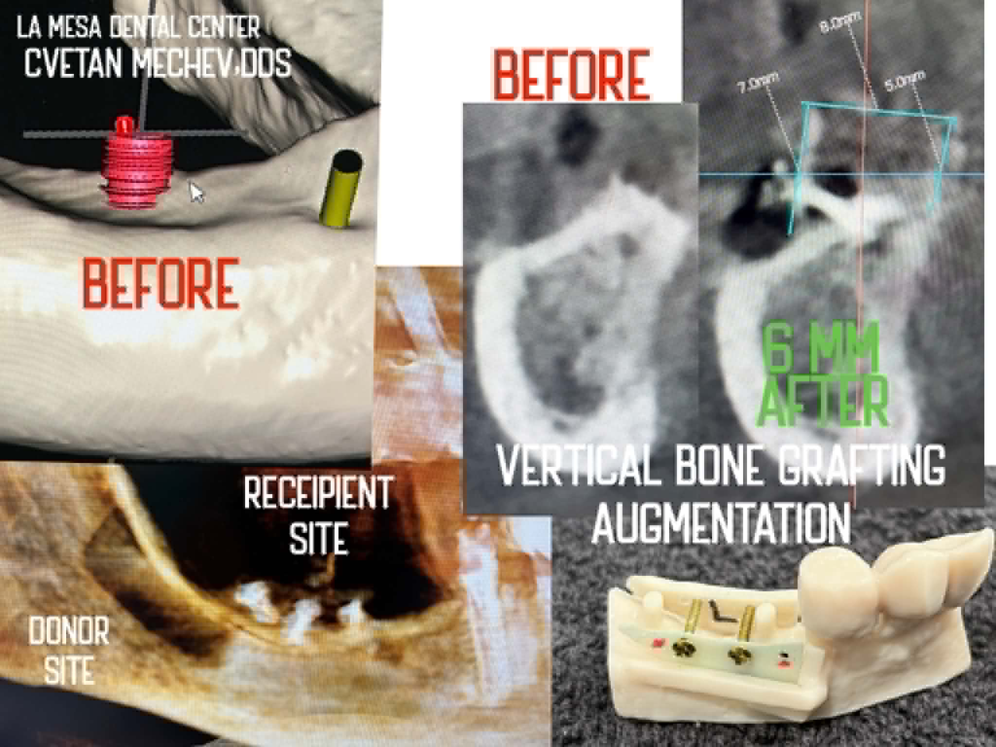Dr. Cvetan Mechev 6mm vertical bone augmentation before and after — La Mesa Dental Center