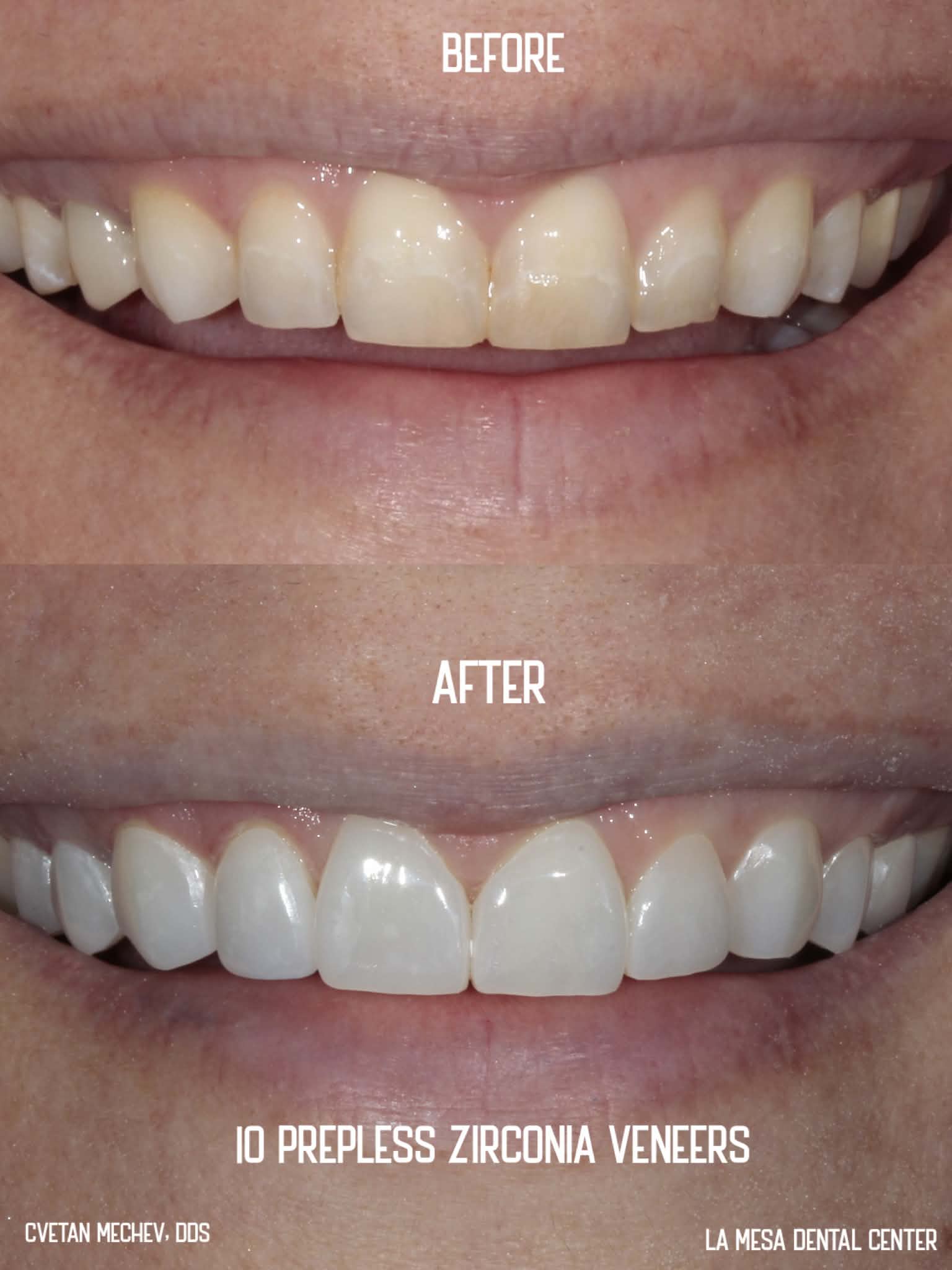 Before and after result of no-prep zirconia veneers by Dr. Cvetan Mechev at La Mesa Dental Center